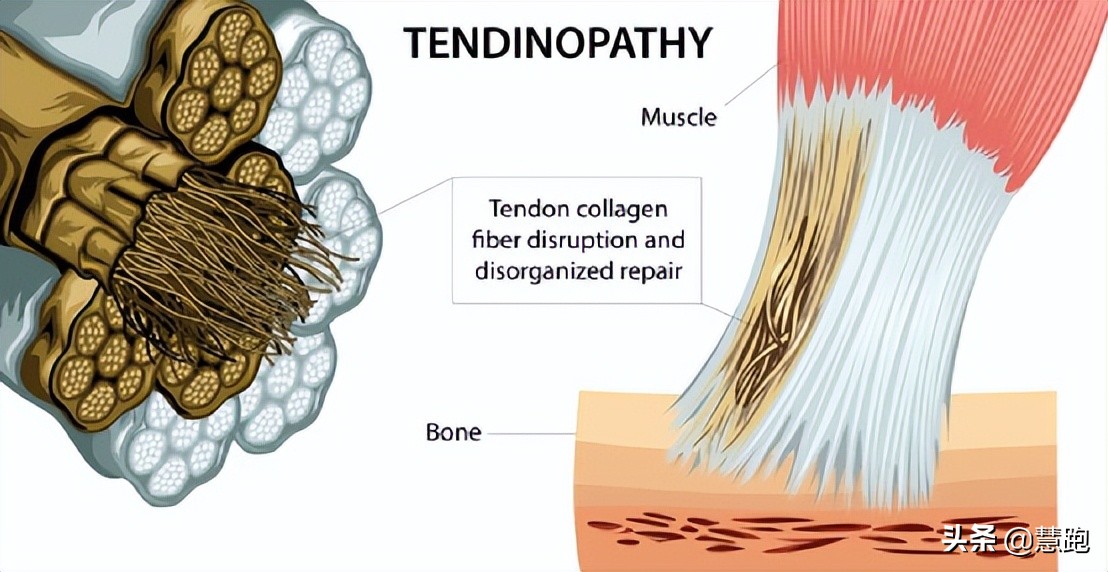 足底筋膜炎久治不愈怎么办,为什么足筋膜炎久治不愈