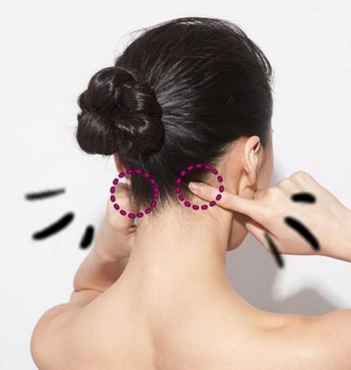 中医扎针治疗偏头痛,夹脊脉冲电针疗法