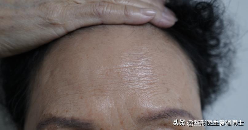 71岁不怕切口长，直接做了大拉皮，第7天拍照看，没敢认啊