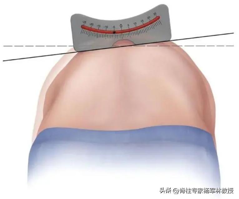 脊柱侧弯10度会出现剃刀背吗,剃刀背会误诊吗