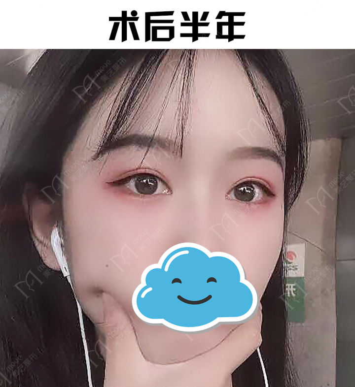 推荐一下哪家医院做双眼皮做得好,推荐双眼皮做得好的医生成都