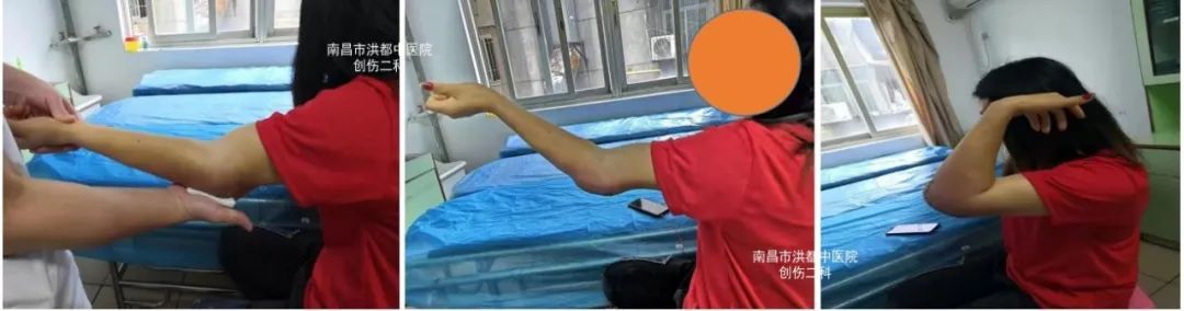 肘关节骨折僵硬康复训练后肿了,肘关节骨折后僵硬的原因