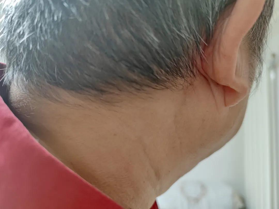 罕见眼病患者的绝望与挣扎,无法治愈的眼疾