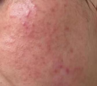 烂脸用什么药膏,这三种药膏千万不能碰