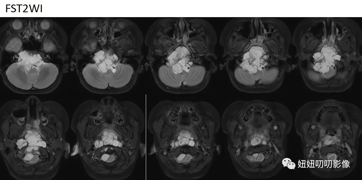 脊索瘤核磁表现,颅底ct头颅ct啥区别