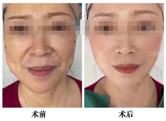 九院面部年轻化有哪些项目,40岁做什么医美项目可以提升脸部