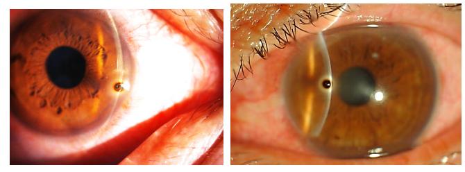 异物入眼能自愈吗,异物科普视频