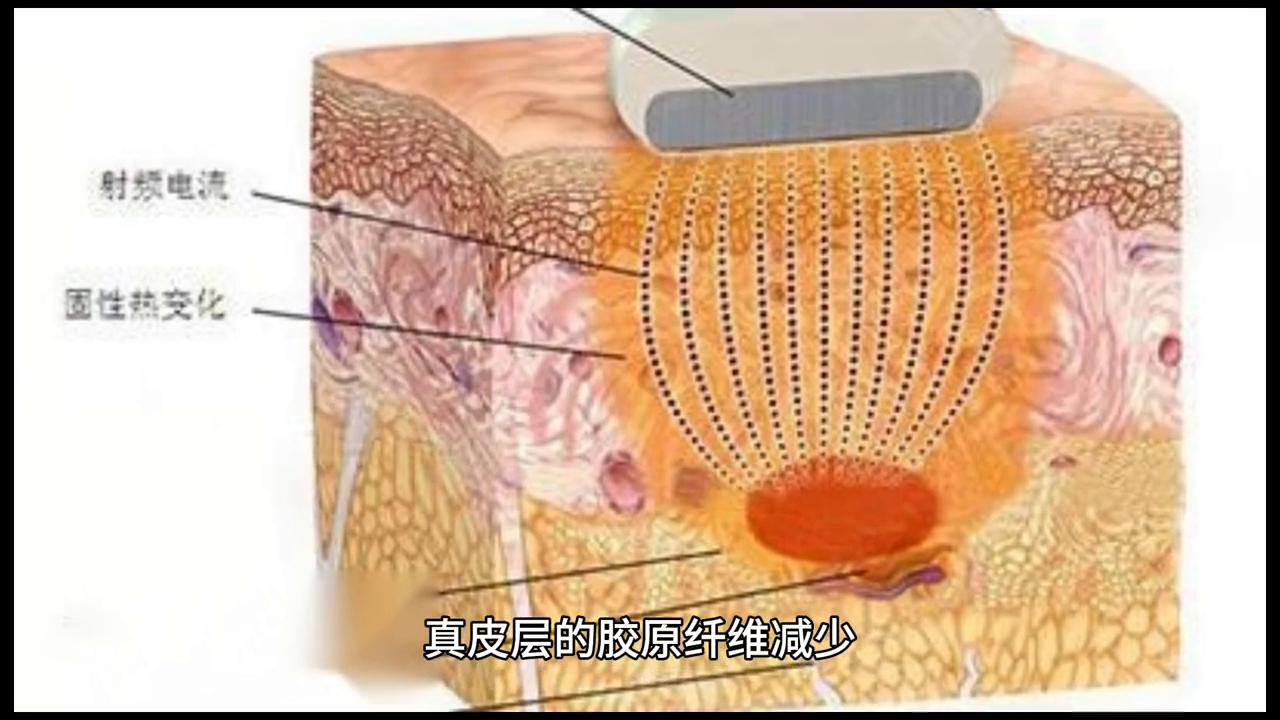 角质层太厚怎么办,角质层太厚是不是也会显黑