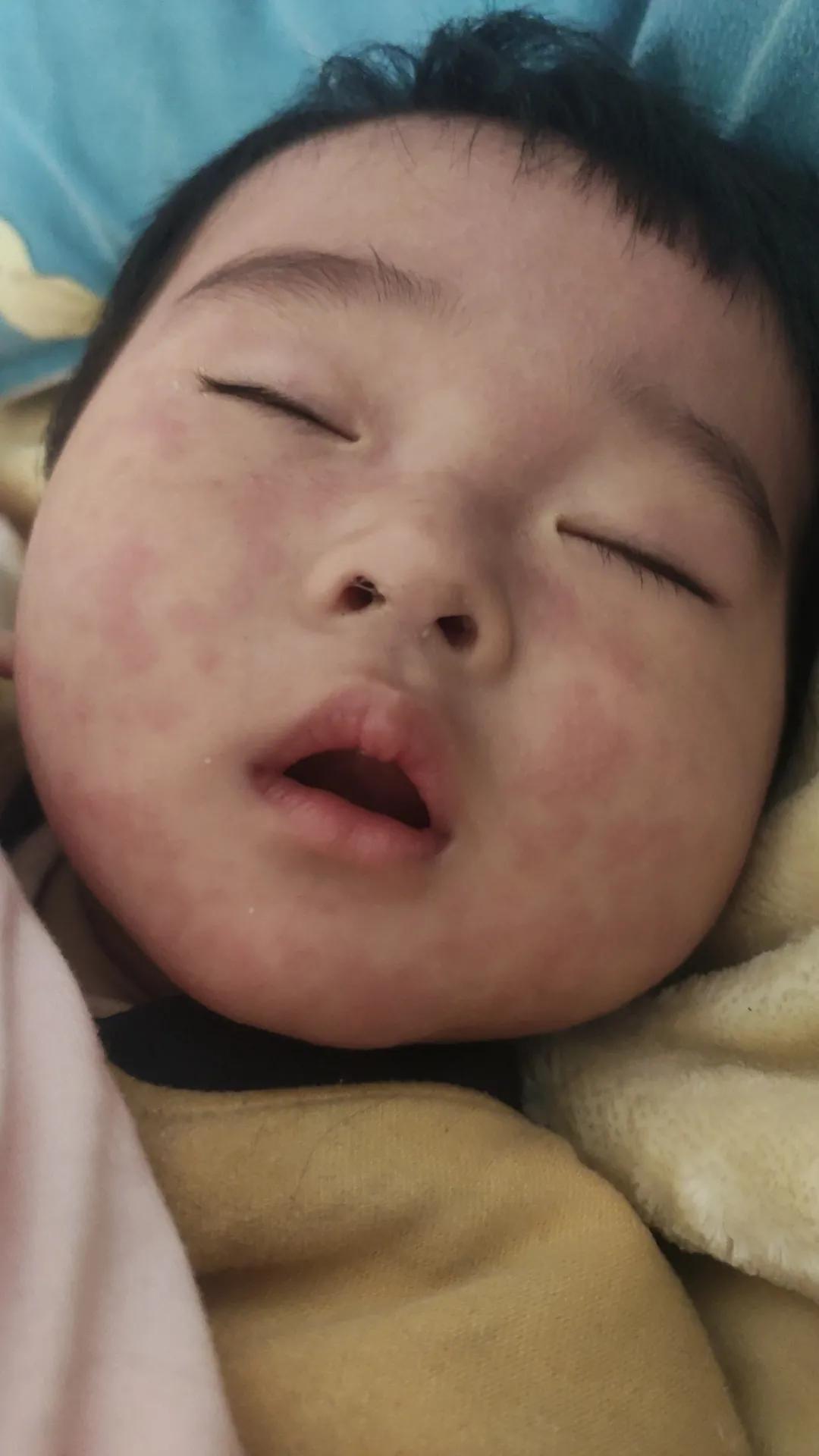 幼儿玫瑰疹的症状,玫瑰疹是幼儿急疹吗