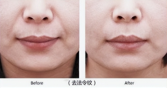 川字纹法令纹最好治疗方法,35岁法令纹类型