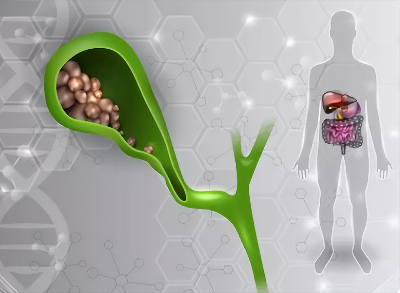 结石要吃什么东西才不会长结石,结石吃什么可以化掉结石最快