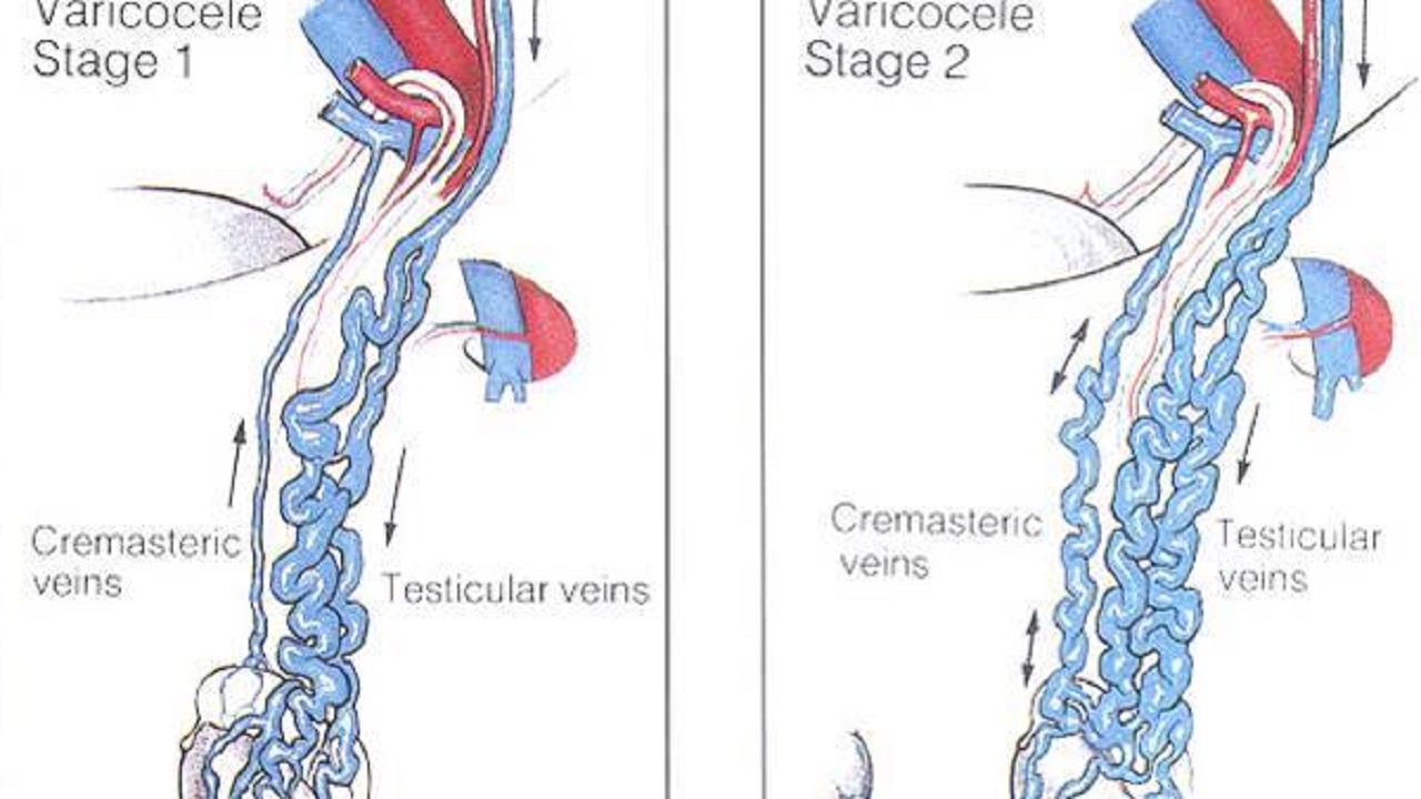 军检精索静脉曲张怎么办,精索静脉曲张军检减缓方法