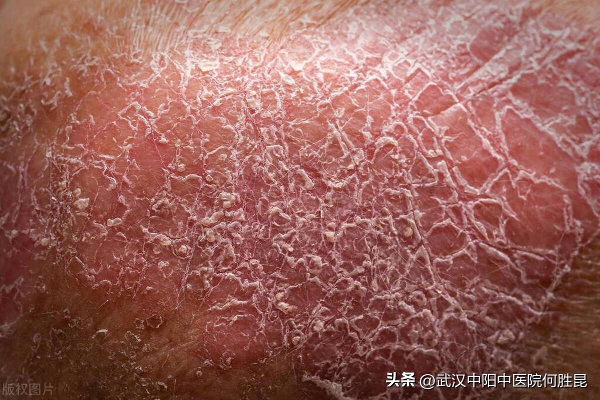 小腿上长了一片暗红癣脱皮痒,小腿上长癣很痒怎么治效果最好