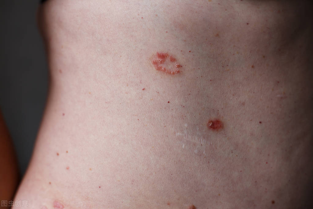 糖友秋冬季好发痒病，需正确分辨才好养病