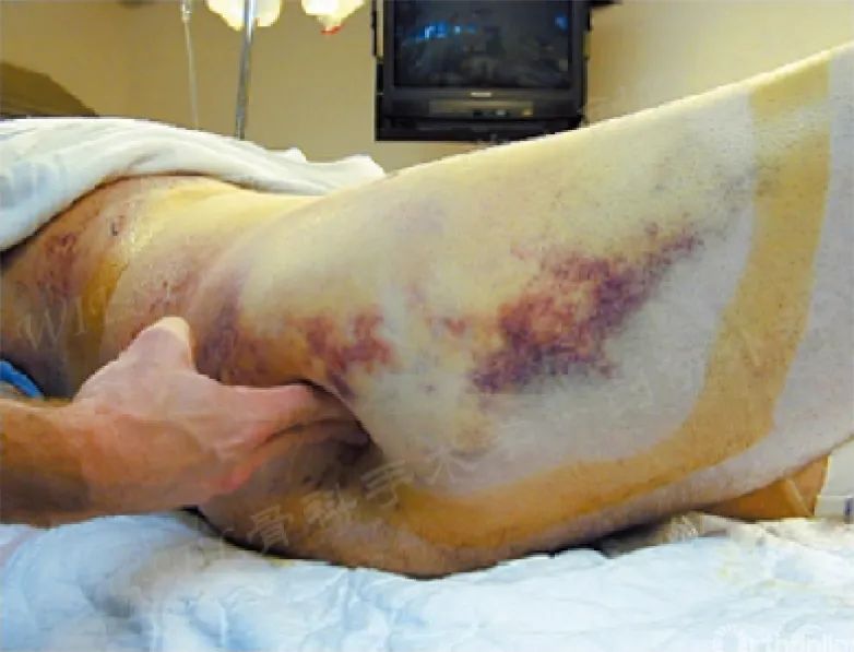 耻骨联合分离和盆骨有区别吗,怀孕耻骨联合分离是怎么回事