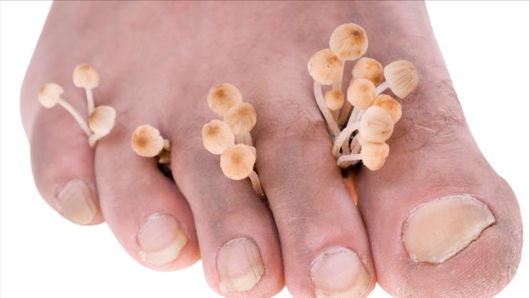 脚气和脚气病有区别？反复发作怎么办？教你2个方法，远离脚气