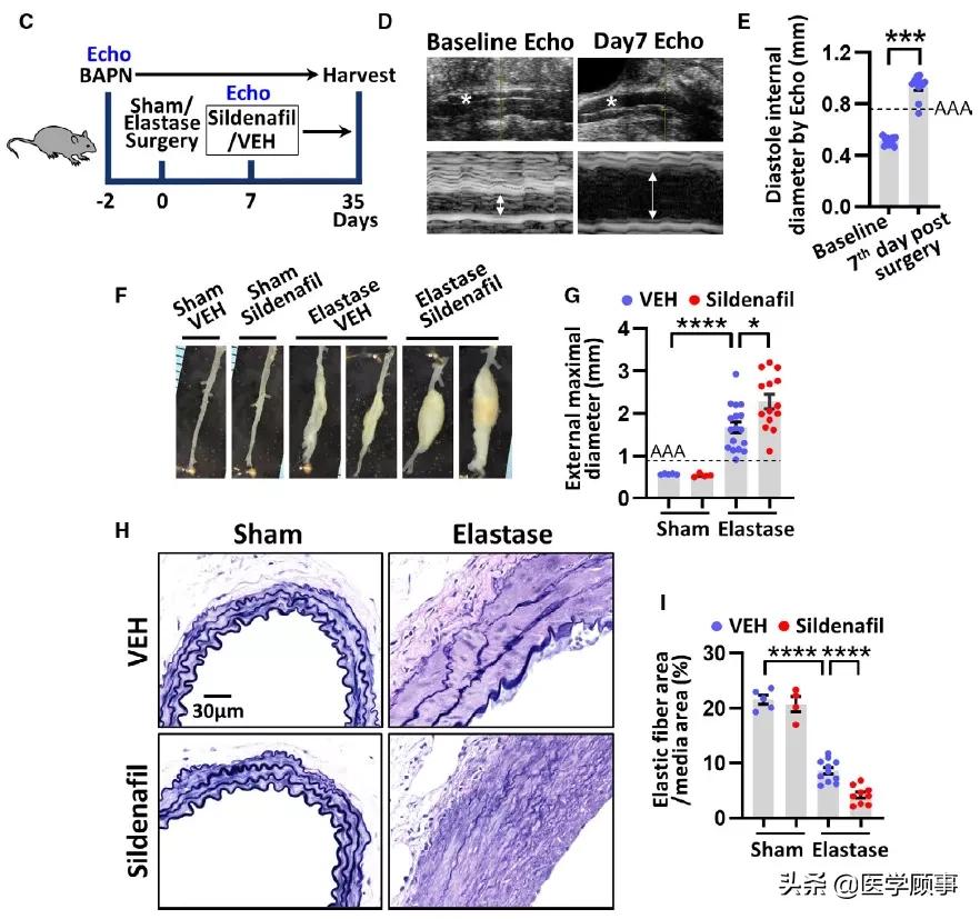 JAHA:“伟哥”被发现可能存在致命副作用,促进腹动脉瘤恶化