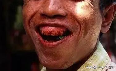 吃槟榔为什么会有害口腔健康,很少吃槟榔对口腔有危害吗