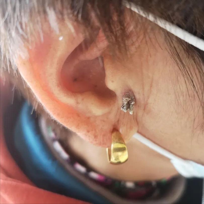 脸上长硬硬的小鼓包,脸上长小米粒疙瘩怎么办