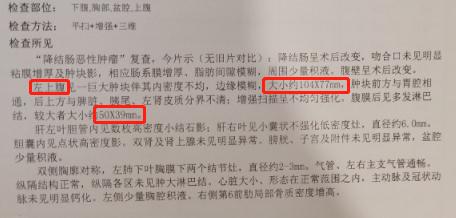 介入手术治疗肠癌,24岁女孩肠癌手术