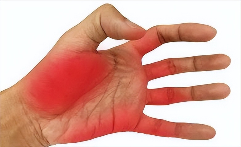 风湿与类风湿性关节炎区别的症状,王医生讲类风湿