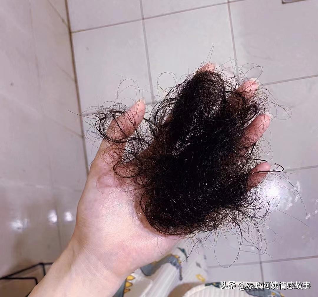 掉发严重头秃了怎么办,掉发严重快秃了怎么办