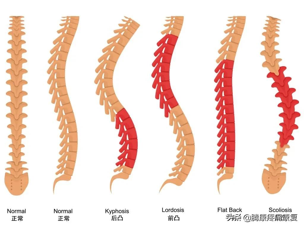 平背的成因,平背怎么造成的
