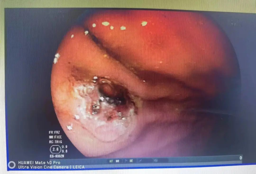 氩气刀治疗,氩气刀微创消融