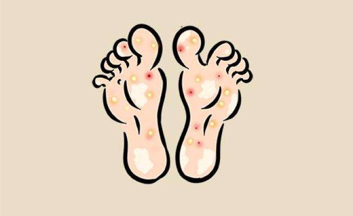 脚气好痒怎么办,脚气太痒怎么办教你一招
