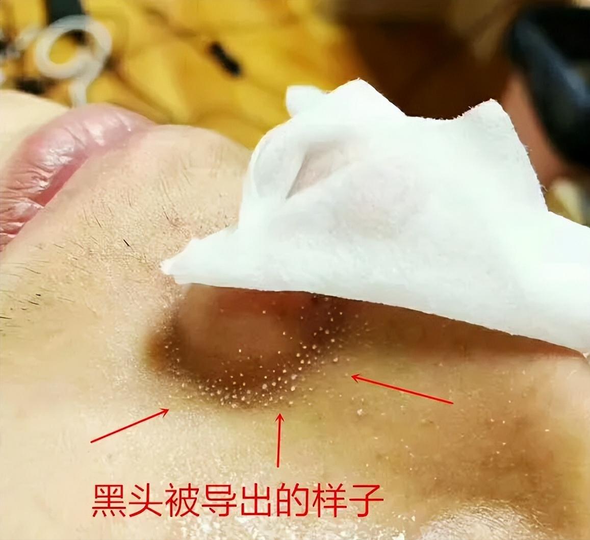 鼻子黑头里挤出的白色油脂怎么办,鼻子上有硬硬的黑头怎么办