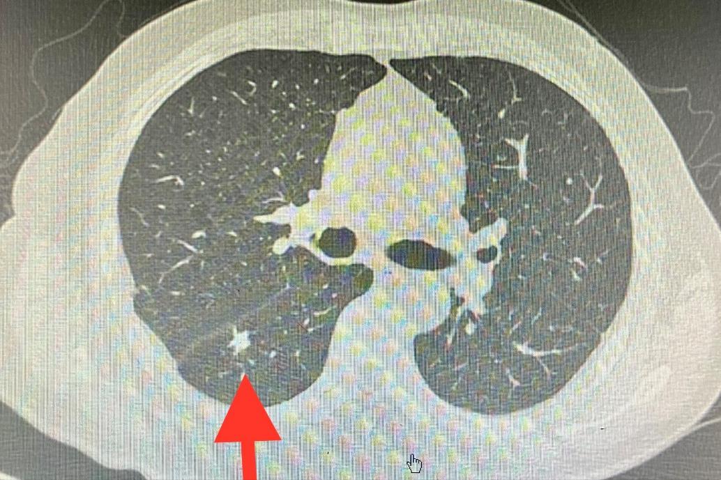经皮穿刺射频消融术胸椎,超声引导微波消融术可以活检吗