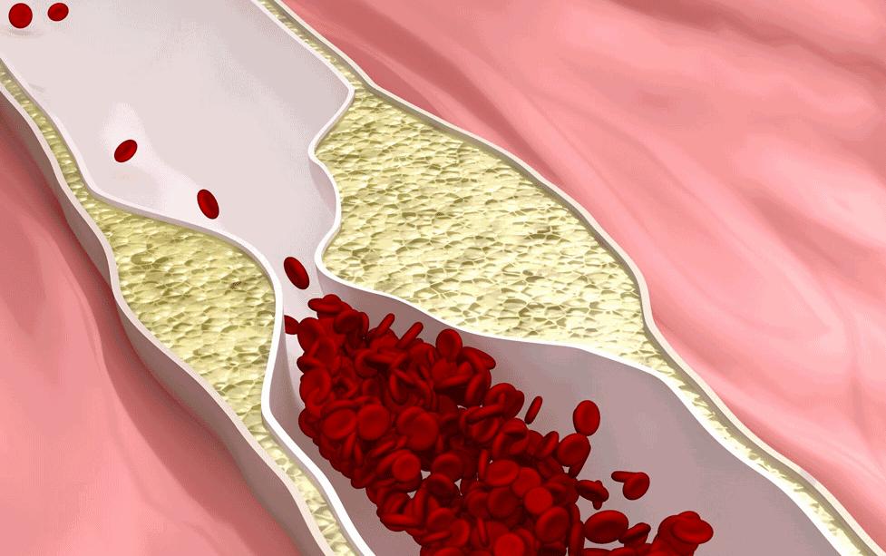 跳绳导致胸椎压缩性骨折,跳绳跳到肋骨脱臼