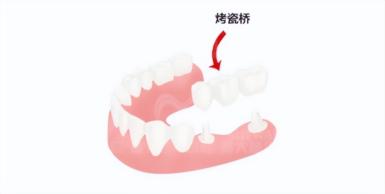 拔牙过后慎吃抗生素,拔牙后千万不要抽烟