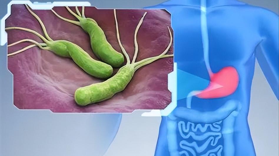 幽门螺杆菌感染阳性可以治好吗,幽门螺杆菌阳性是不是很严重