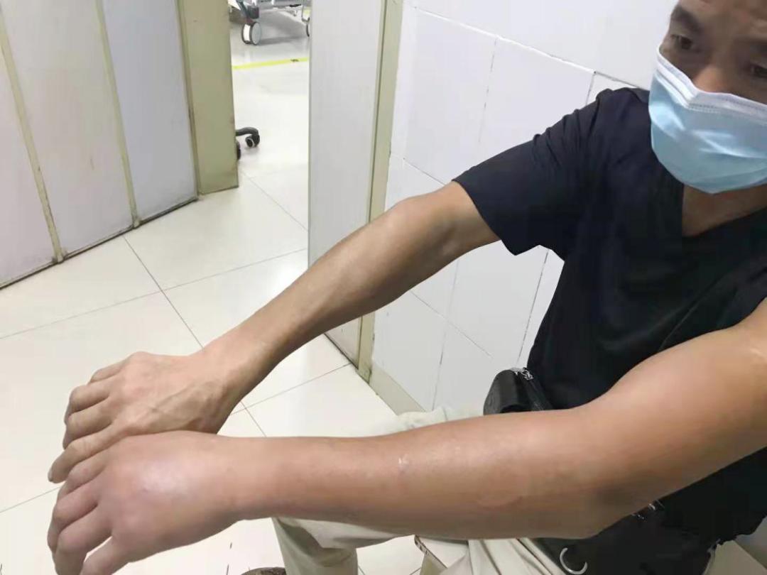 蜂蜇伤最好的处理方法,蜂蜇伤怎么处理