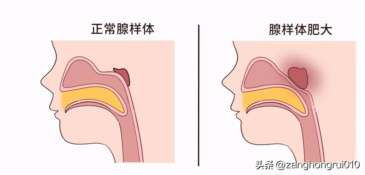 腺样体肥大引起的并发症能好吗,儿童腺样体肥大症状及表现