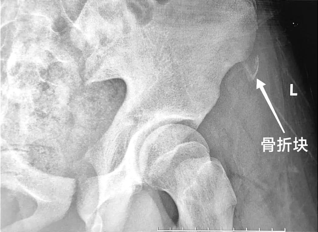 跑完步发现膝盖剧痛怎么办,跑完步为什么腿里有根筋痛