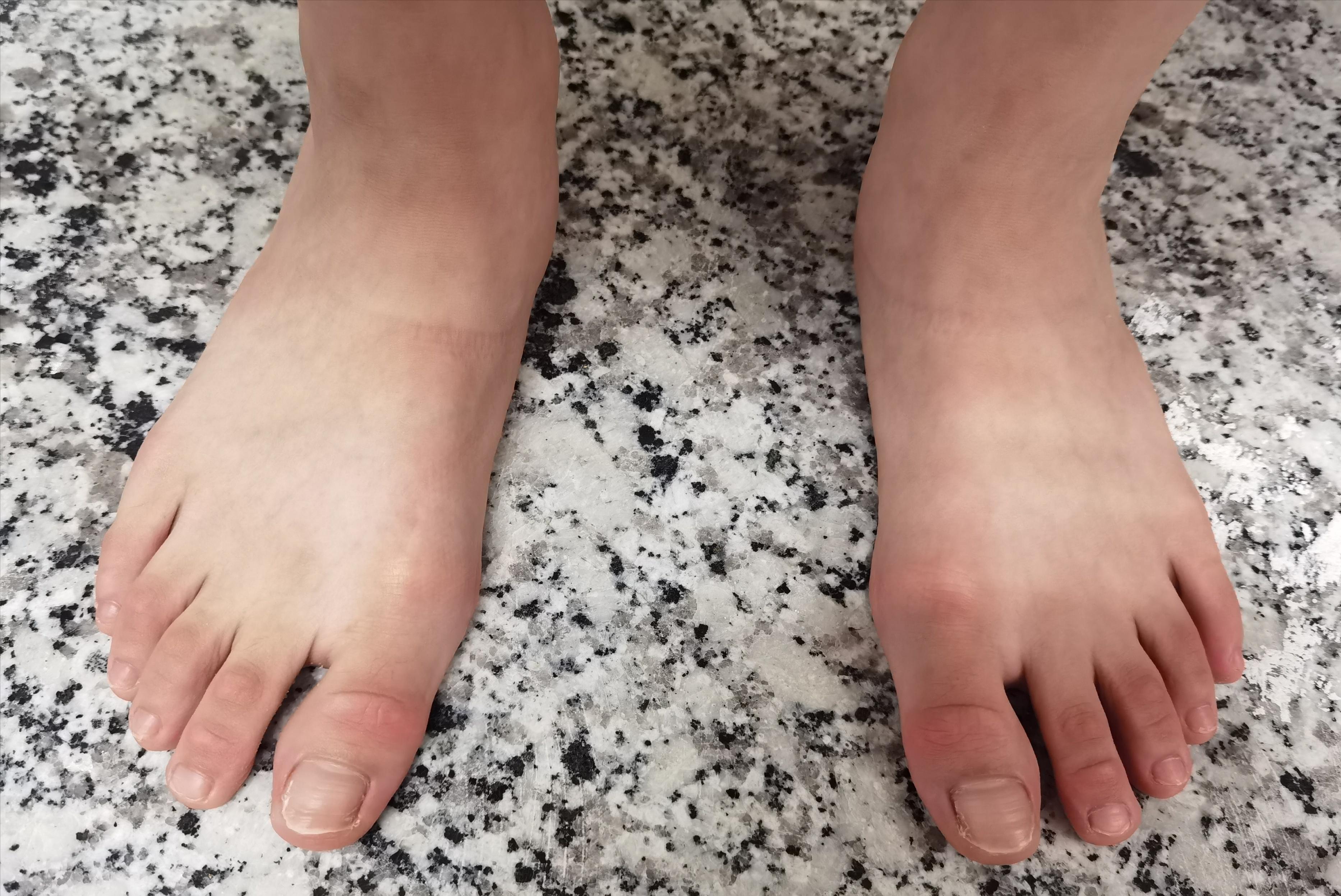 扁平足穿鞋垫能矫正过来吗,僵硬型扁平足矫正鞋垫有效果吗