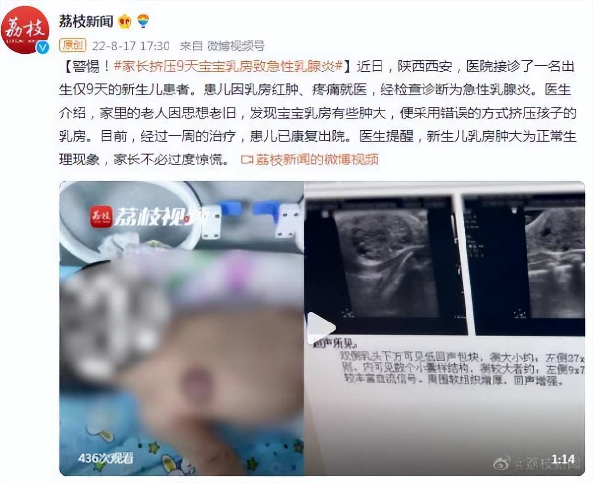 急性乳腺炎早期症状哪项不正确,乳腺炎堵奶硬块大人怎么吸