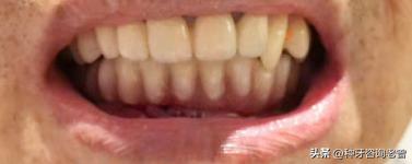 做了种植牙后的真实感受,种植过牙的人亲身经历