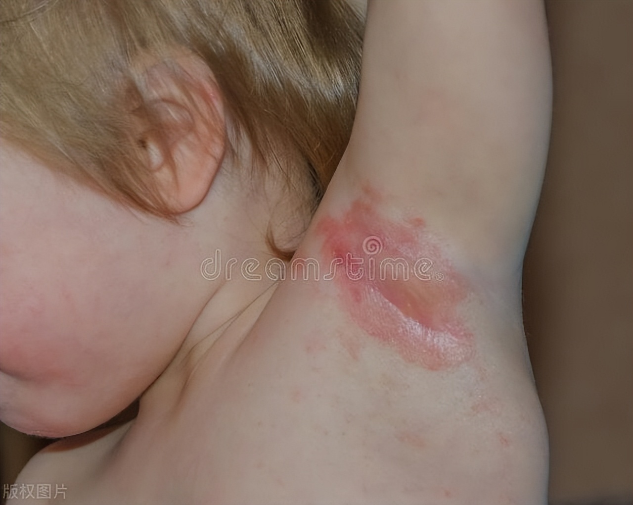 别把艾滋病当皮肤病,艾滋病前期会有皮肤病么