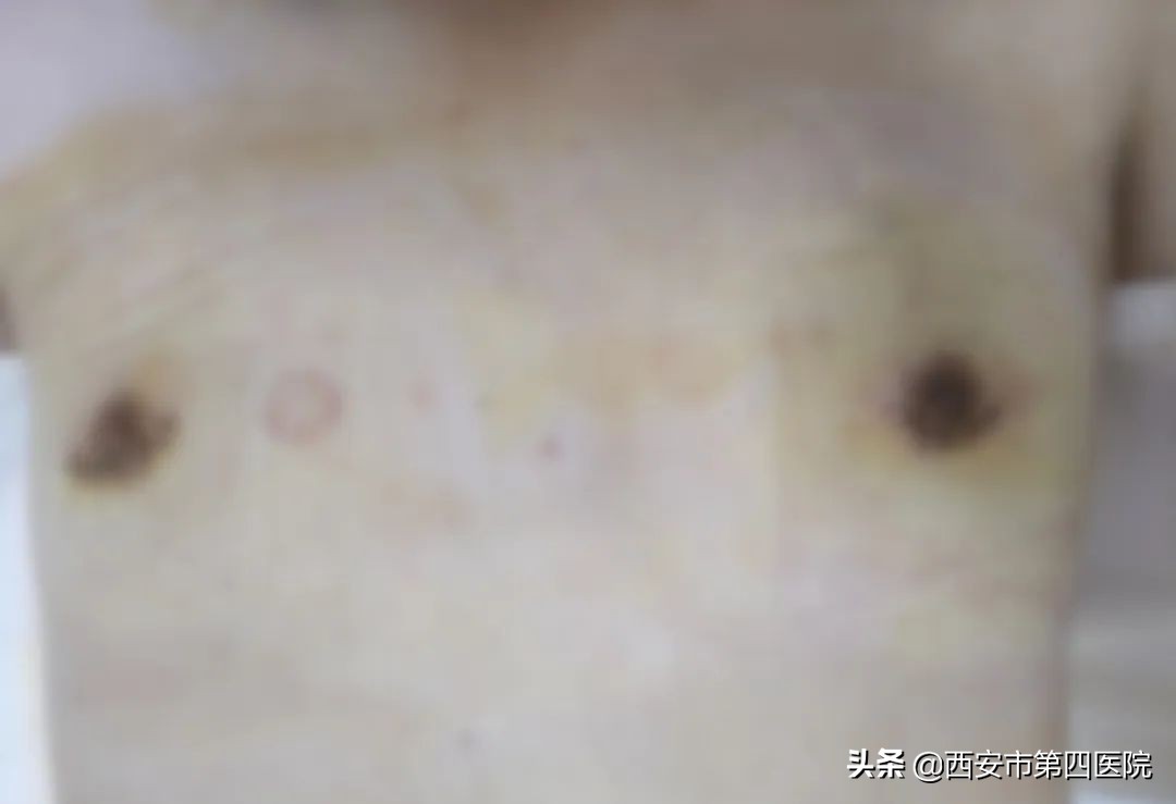#健康中国行动2030#胸大真尴尬，18岁小伙胸部异常隆起……这个病也会找上“他们”