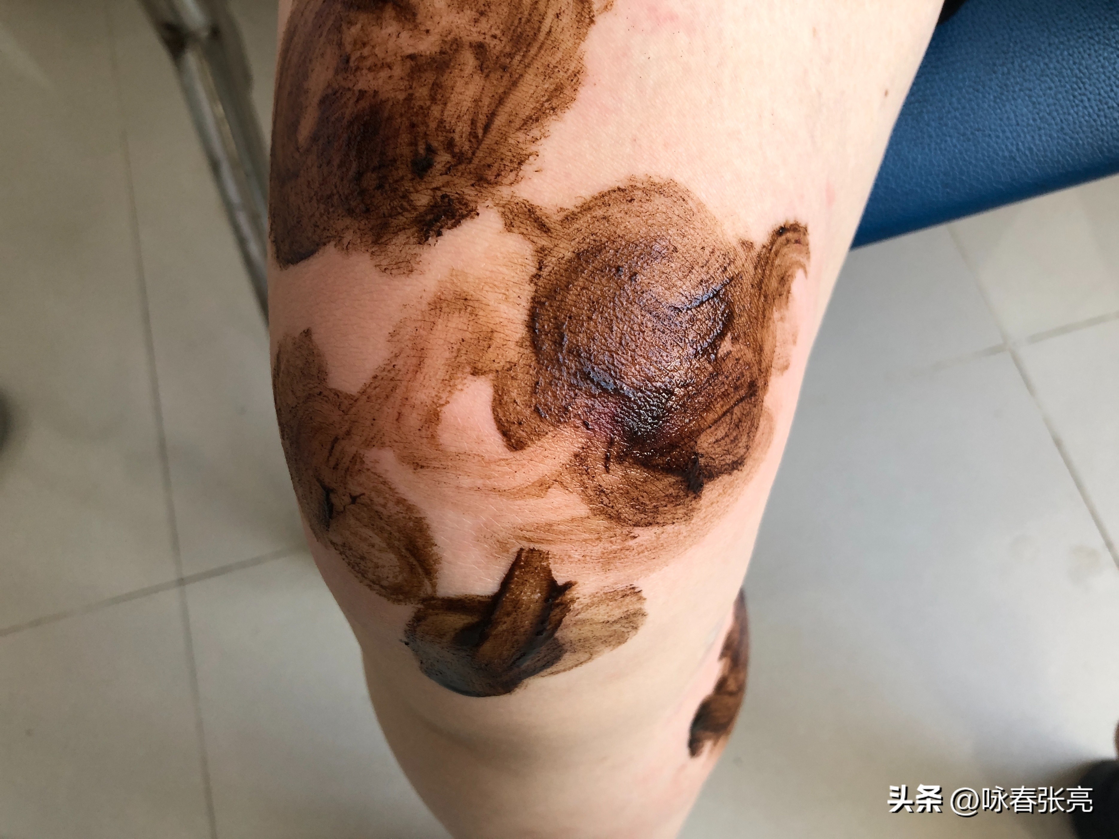 被蜈蚣咬了疼还是被蜜蜂蛰了疼,科普被蜈蚣咬了怎么处理