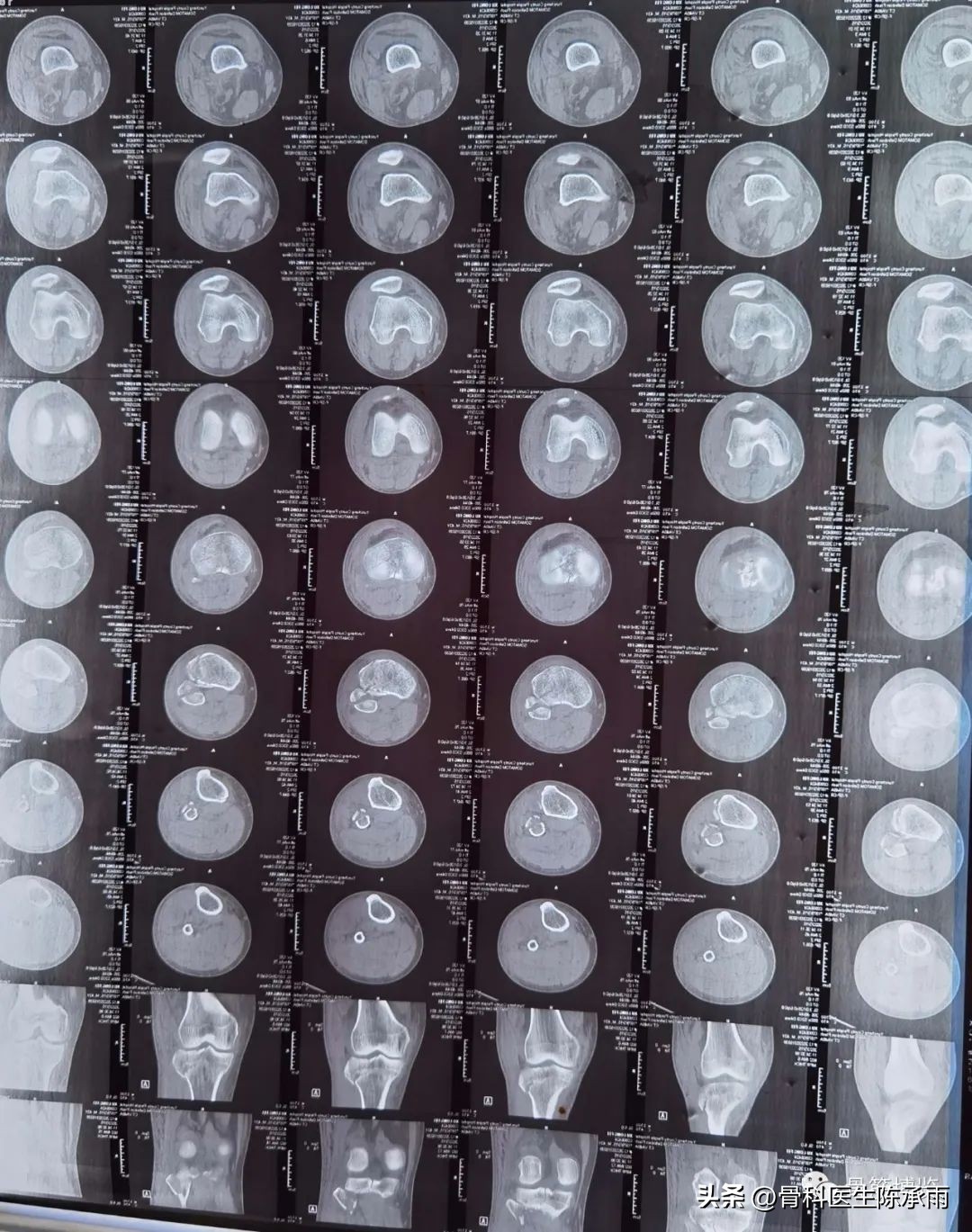 膝关节胫骨平台骨折,最近胫骨平台骨折视频