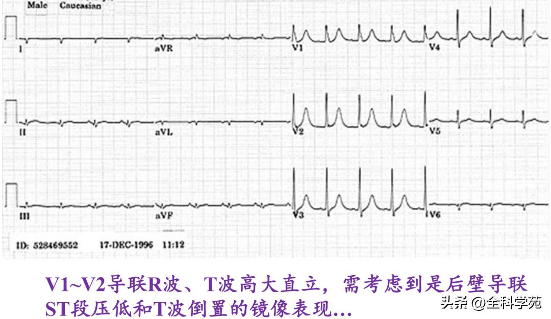 t波高尖心电图判断标准,t波高尖判断标准