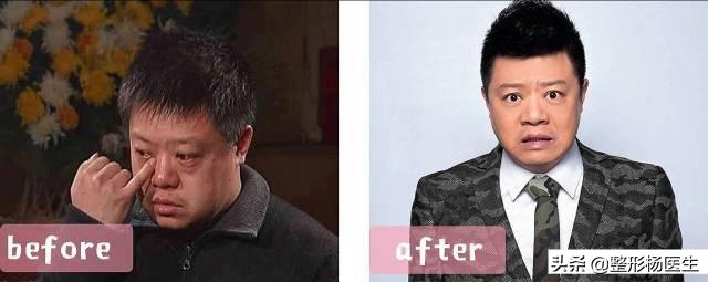 眼袋手术后真的显年轻吗,割眼袋能年轻几岁