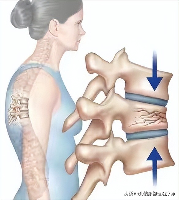 老年人腰部压缩性骨折怎么治疗,腰部压缩骨折多久才能恢复