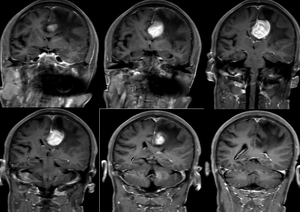骨软骨瘤mri,颅骨血管瘤mri表现