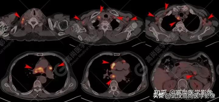 10毫米的肺结节恶性死亡率有多大,1厘米多的肺结节良性可能性多大
