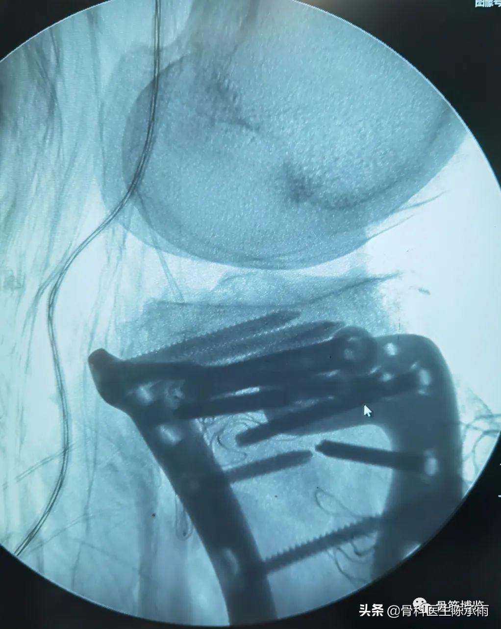 陈旧性腿骨骨折,陈旧性骨折